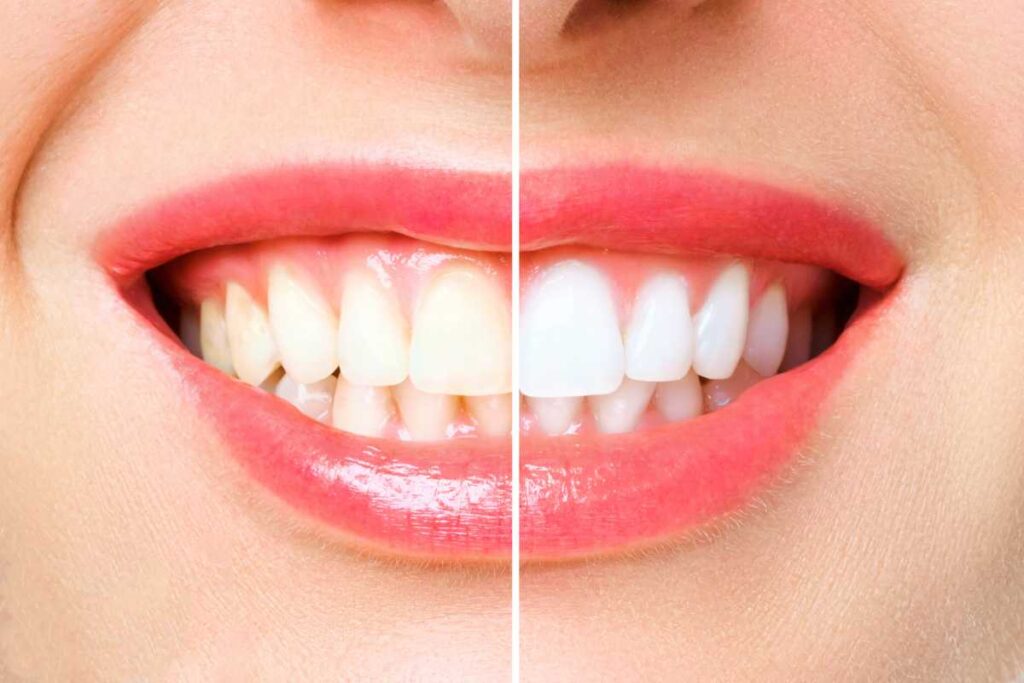 Denti bianchi prima dopo